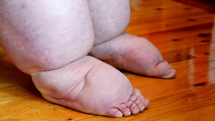 The swelling in Karen Bingham's feet vary by day.