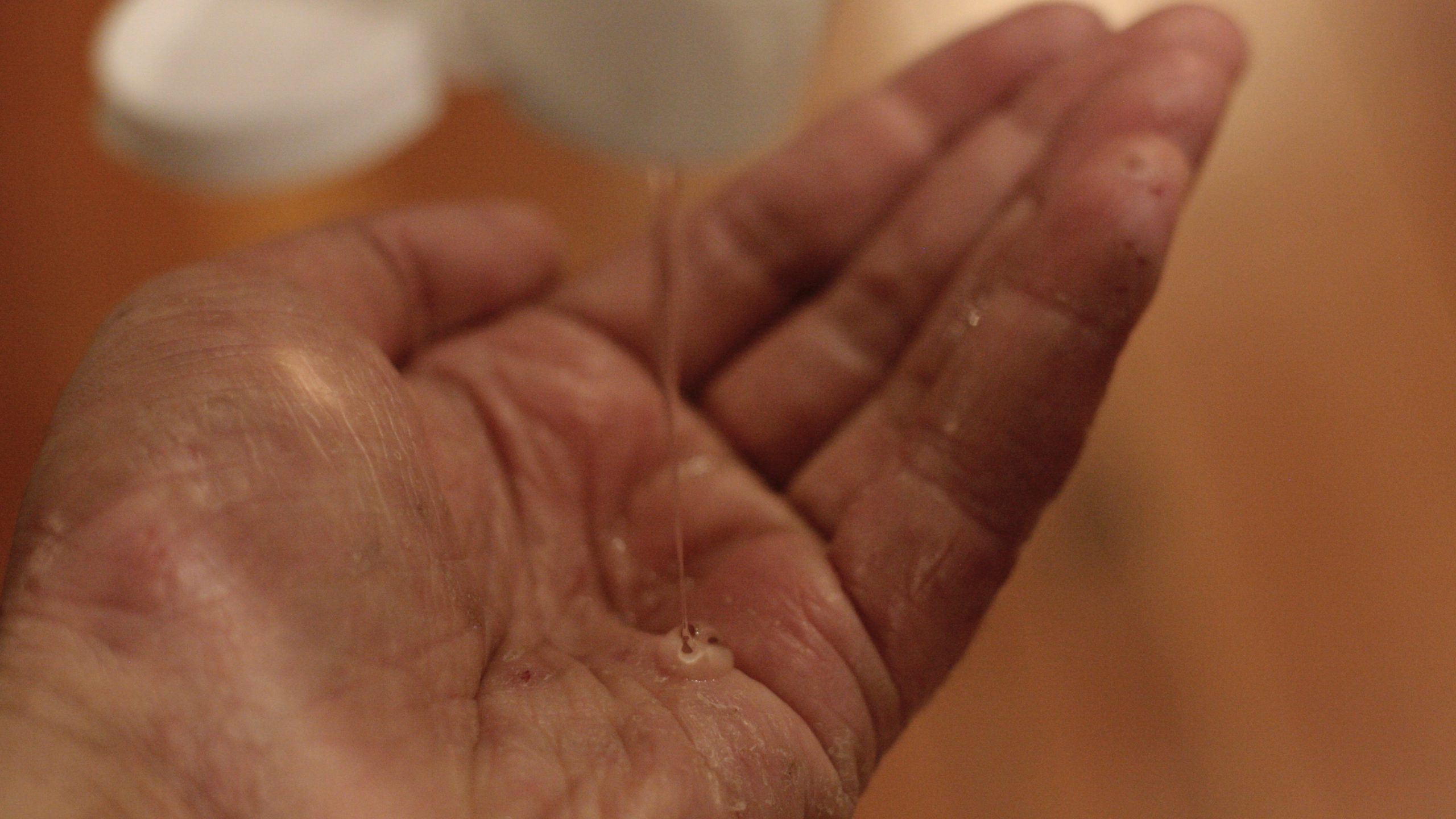 Hand sanitizer being pored on hands that show signs of eczema.