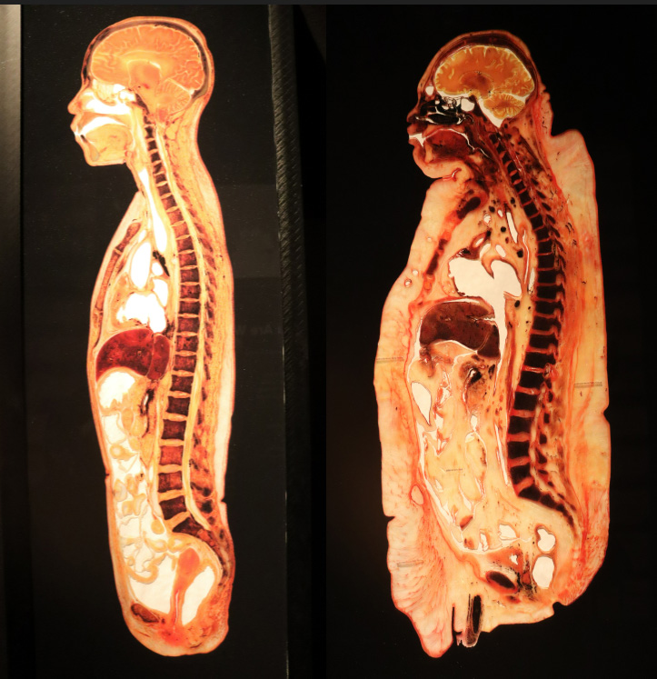 Nova Scotia Museum showcases return of human cadaver show Body Worlds